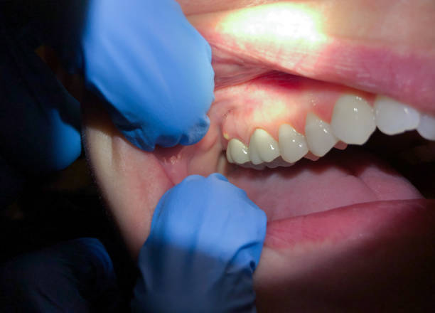 Best Urgent Care for Lost Fillings or Crowns in Lantana, FL