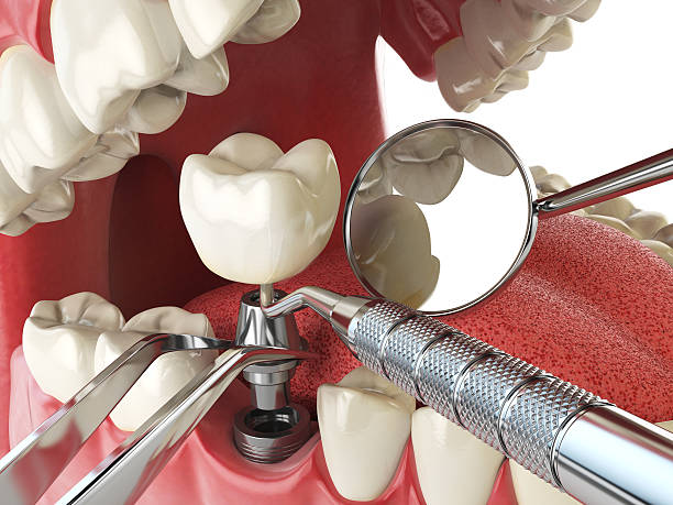 Best Emergency Treatment for Dental Infections or Abscesses in Lantana, FL